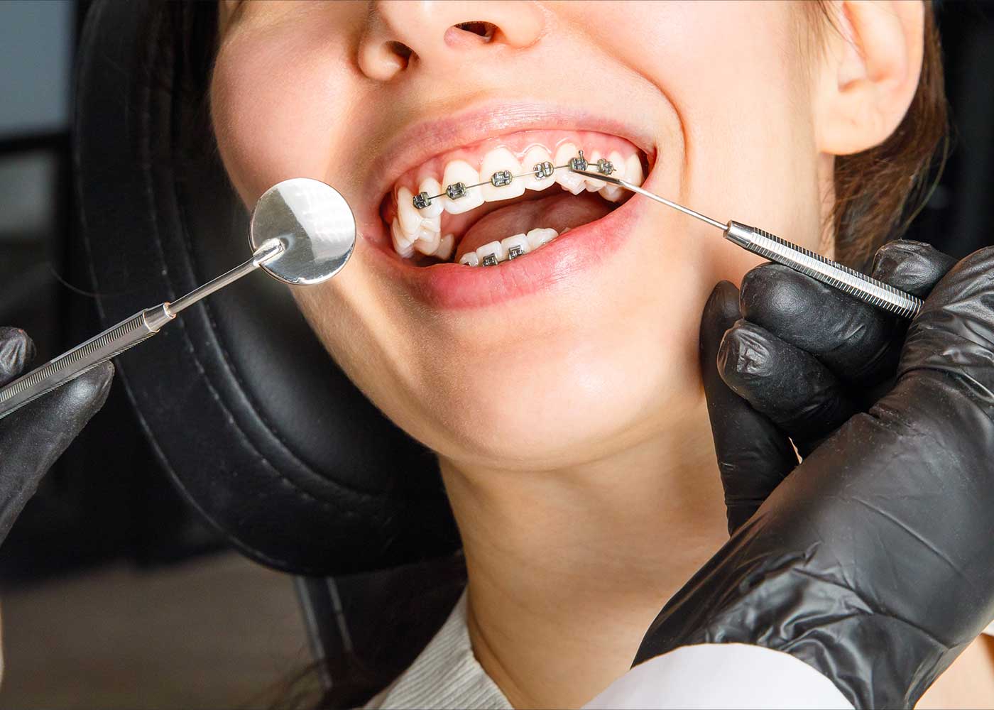 Are Braces TaxDeductible? Understanding Medical Expense Deductions