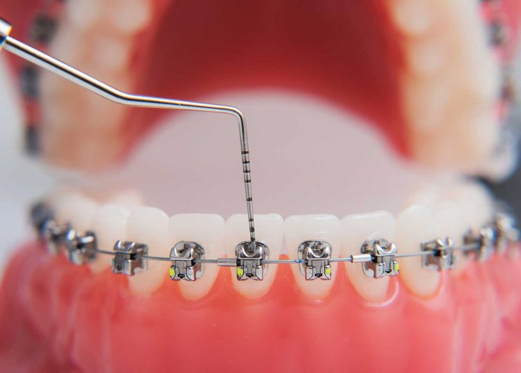 Are Braces TaxDeductible? Understanding Medical Expense Deductions